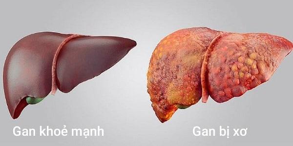 Gan khỏe mạnh và gan bị xơ