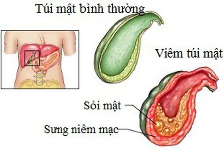 Sỏi túi mật là nguyên nhân chính gây ra viêm túi mật.