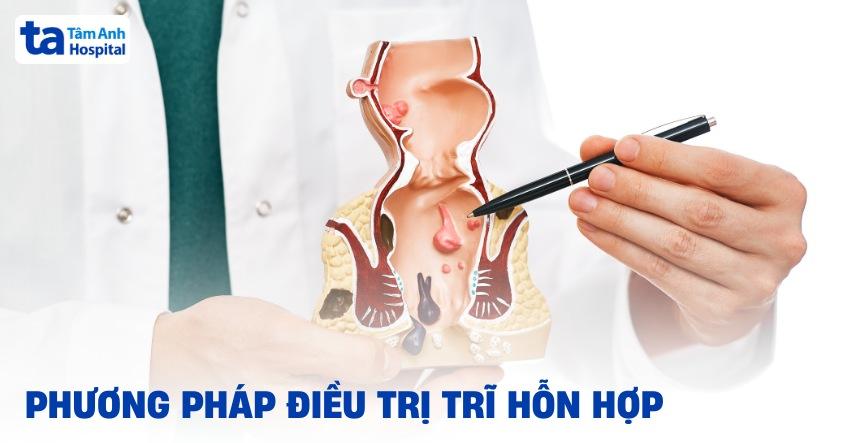 điều trị trĩ hỗn hợp