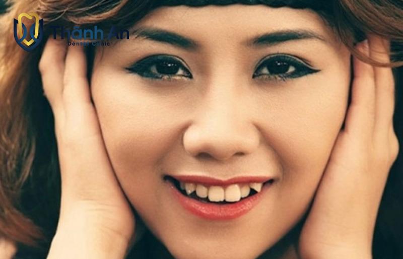 Hình Ảnh Các Kiểu Răng Khểnh Đẹp Đáng Để Tham Khảo