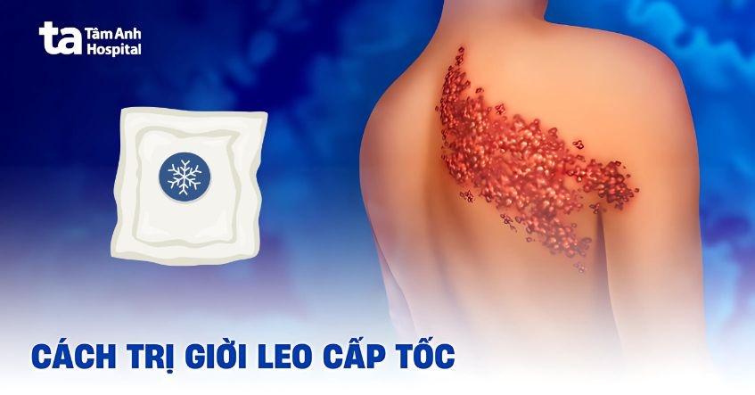 6 cách trị giời leo cấp tốc an toàn hiệu quả được bác sĩ tin dùng
